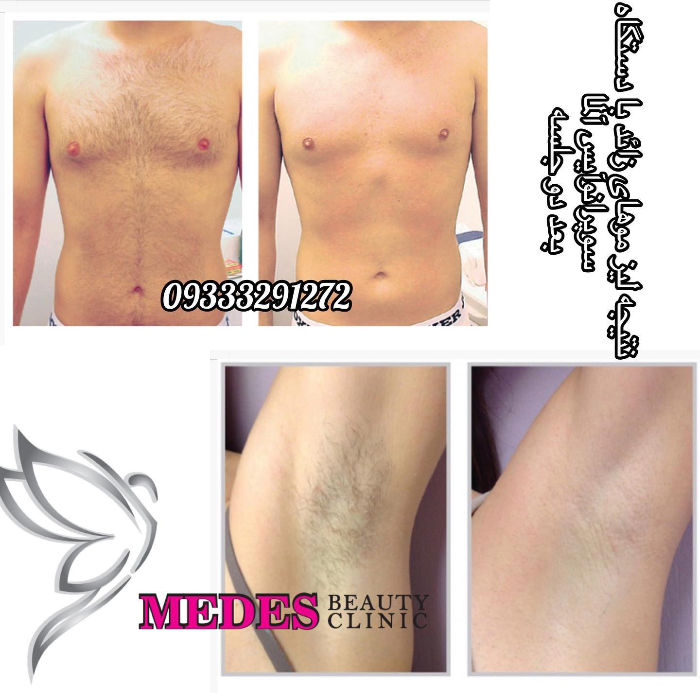 گالری لیزر مو زائد